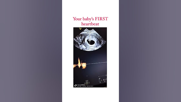 Your Baby’s FIRST Heartbeat on Ultrasound!💓 #drbhumikabansal #heartbeat #pregnancy #trending #short