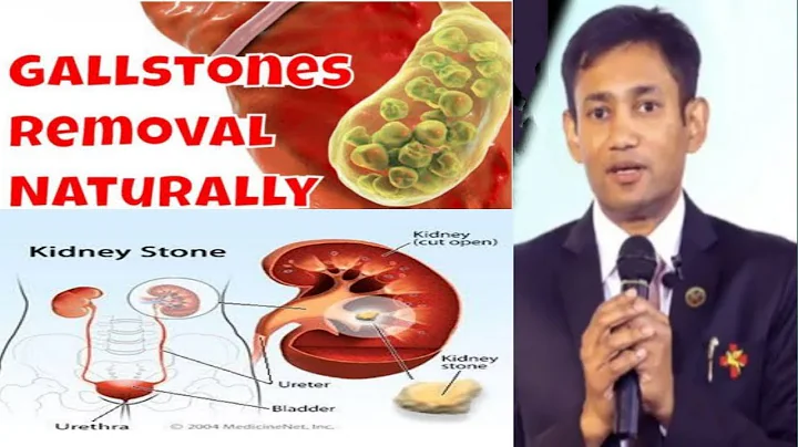 (stone )|| Gallbladder stone, Kidney stone Natural...