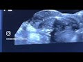 Watch the real moment of hope🤍. Ultrasound- guided embryo transfer 