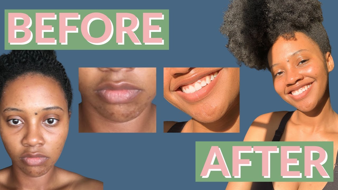 Affordable Skincare Routine For Acne & Dark Marks | How I Cleared My ...