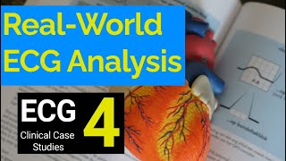 Real-World ECG Analysis (4): Clinical Case Studies in Electrocardiography.