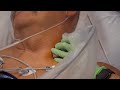 Interscalene Nerve Blocks: Shoulder surgery anesthesia at the Total Joint Center