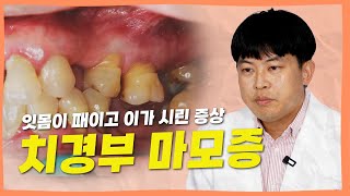 이가 시리고 잇몸이 패이는 치경부 마모증 방치하시면 안됩니다