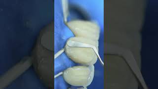 composite  installation process #shorts #dentist #dental #implant #veneers