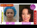 Блефаропластика в Ташкенте, подтяжка лица, Консультация.