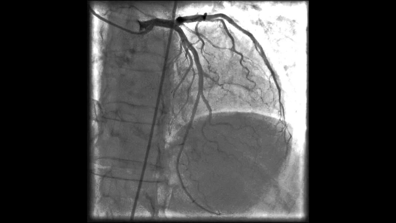 Coronary Angiography Catheter YouTube Coronary Angiography Catheter YouTube