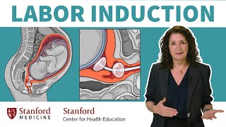 What is labor induction? OB\/GYN answers 5 common questions about inducing labor | Stanford