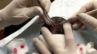 Squeezed out this pilar cyst - the sac was too friable. For medical education- NSFE.