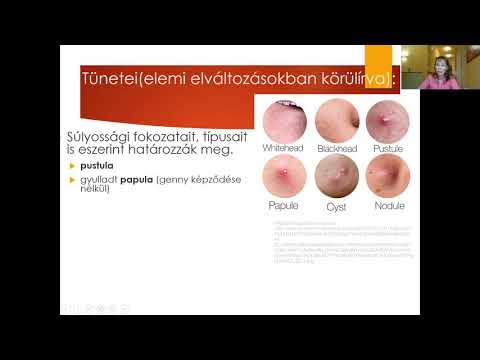 Videó: Genitális Psoriasis: Tünetek, Kezelés és így Tovább