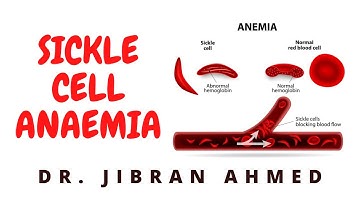 SICKLE CELL ANAEMIA II HEMOLYTIC ANAEMIA II ROBBINS 10TH E II PATHOLOGY LECTURE