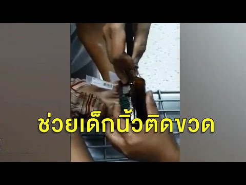 ลุ้นช่วยเด็ก 3 ขวบเล่นซน นิ้วติดขวดเครื่องดื่มชูกำลัง หมอต้องเรียกช่างกระจกมาช่วยตัดขวด