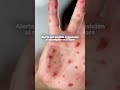 Alerta por posible exposición al sarampión en O’Hare