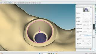 HyperDENT Titanium Implant Malone Bridge