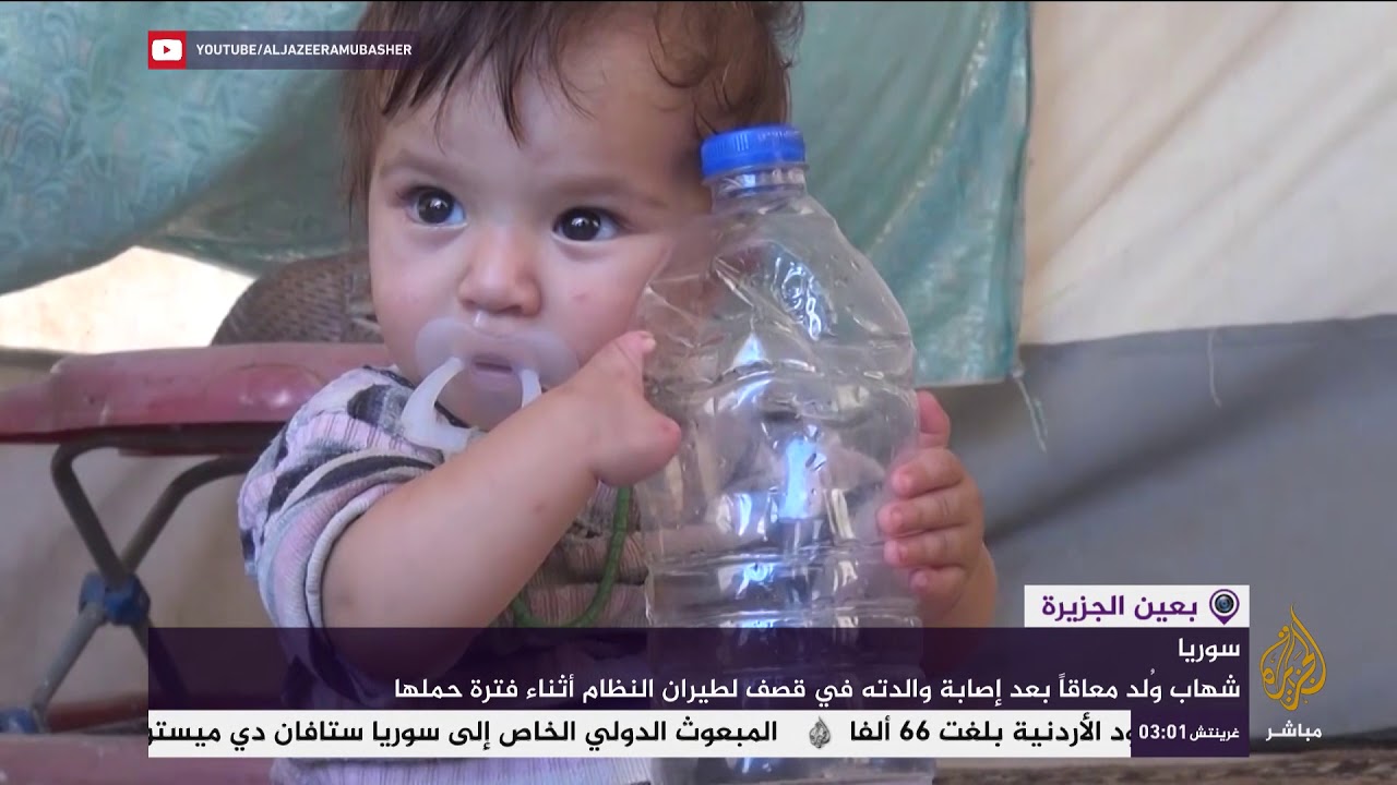 طفل سوري يعاني بسبب تشوهات الحرب