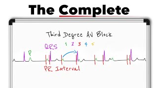 Third-Degree AV Block (Complete Heart Block) ECG Explained | ECG Interpretation made easy Wealth