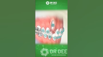 ✅ Đưa răng nanh về đúng vị trí