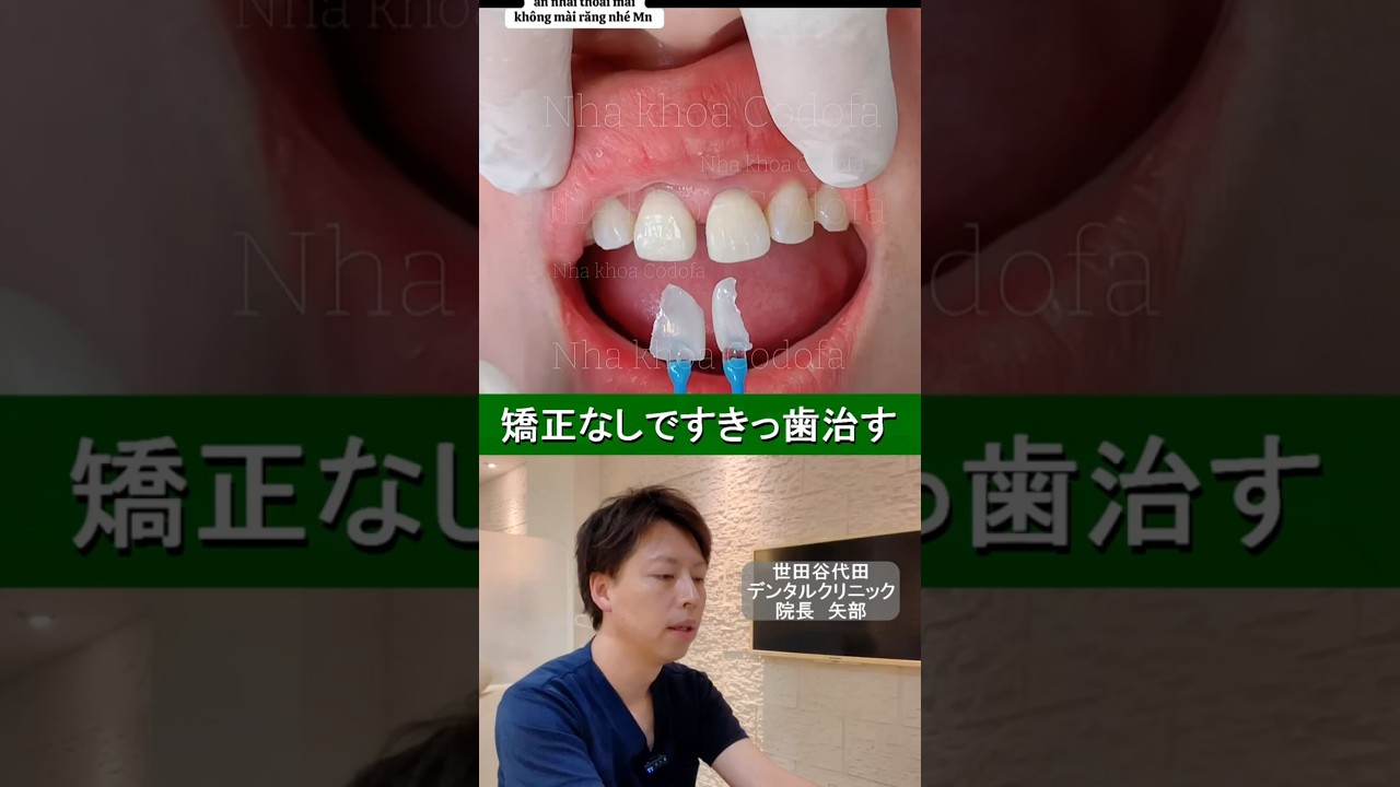 矯正しないで前歯のすき間を埋めました★#すきっ歯 #前歯のすき間 #歯並び #矯正 #セラミック #ベニア治療 #審美歯科