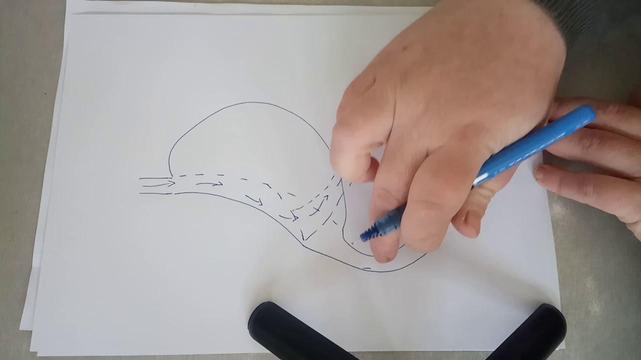 הסבר על ניתוח מיני מעקף קיבה עם דף ועט