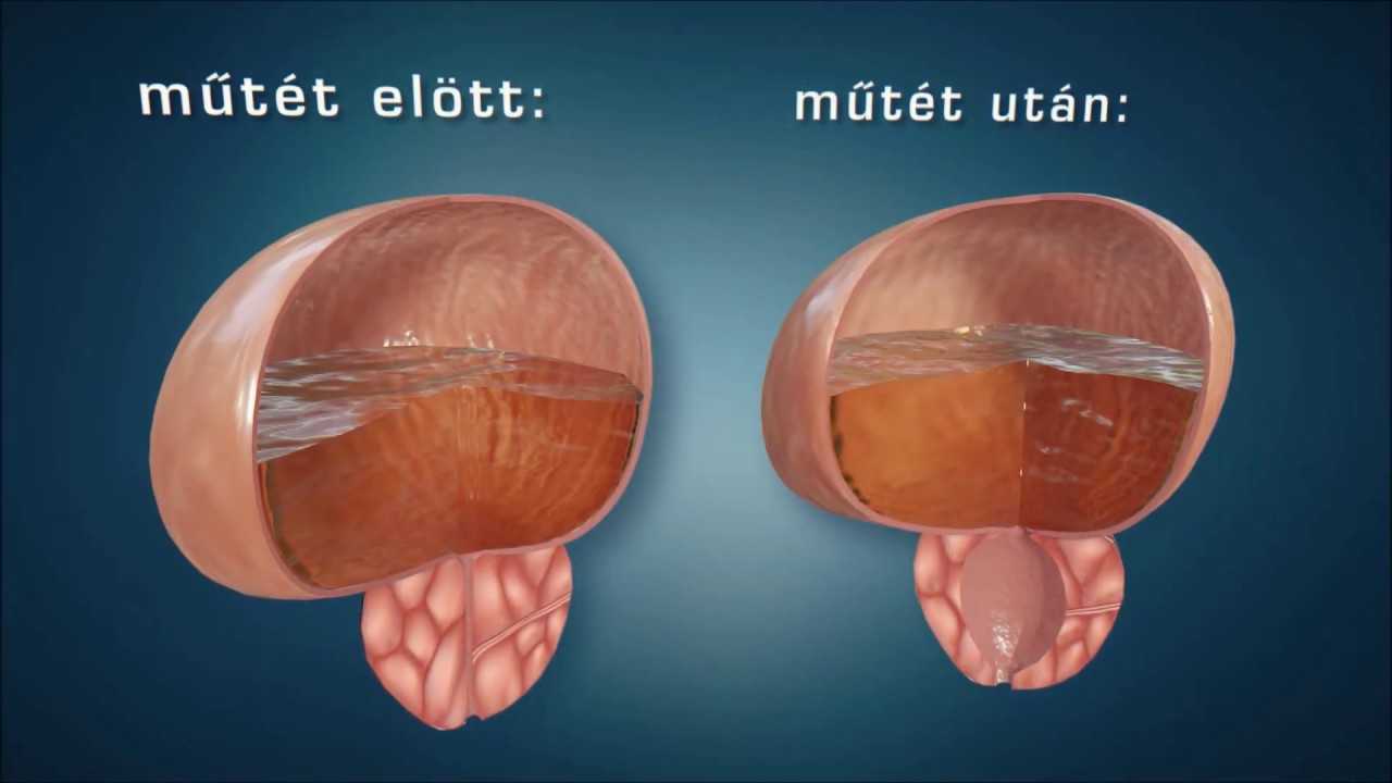 pénisz a megnagyobbodás előtt és után