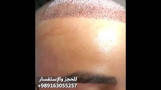 زراعة الشعر في شيراز