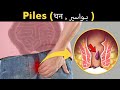 What Happens In Piles (Haemorrhoids, Bawaseer (بواسیر) | Symptoms, Causes And Treatment (Urdu/Hindi)