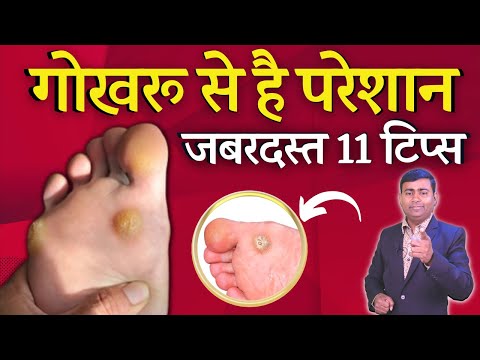 वीडियो: गोखरू से छुटकारा पाने के 3 तरीके