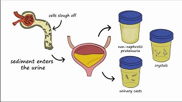 Analgesic Nephropathy (AN), Kidney Damage from NSAIDs
