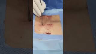 Best Spine Treatment Doctor in Srinagar | OLLIF Percutaneous Endofusion | Spine Maters