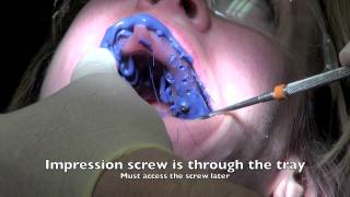 Dental Implant - Impression and Insertion of crown(over 1500000 views on 