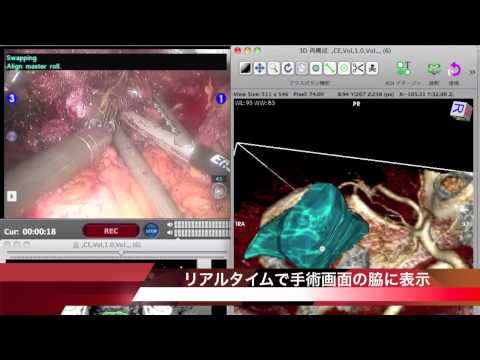 ロボット前立腺摘除手術（ダ・ヴィンチ手術）＠帝京大学病院