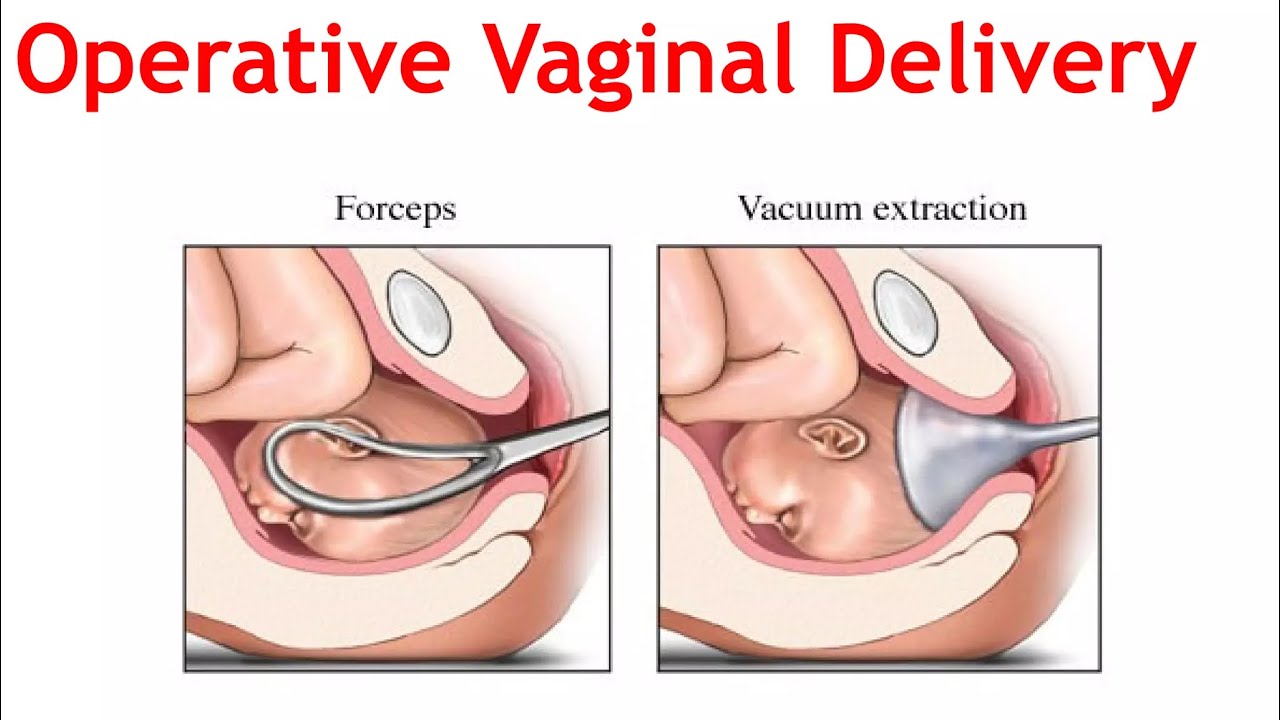 Operative vaginal delivery