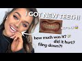 MY COMPOSITE VENEERS/BONDS EXPERIENCE! 😁 ANSWERING WHAT YOU WANT TO KNOW! | Rachel Leary