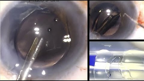 Broken haptic during IOL injection - here