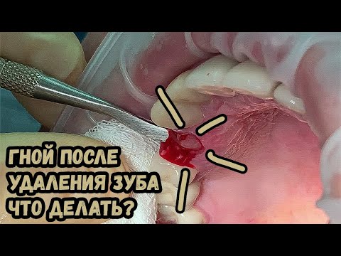 Гной после удаления зуба, лечение альвеолита