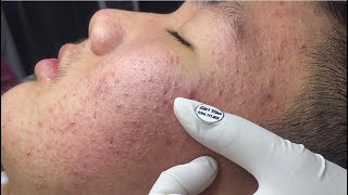 Acne treatment for Spa Linh Mun 2024 #76