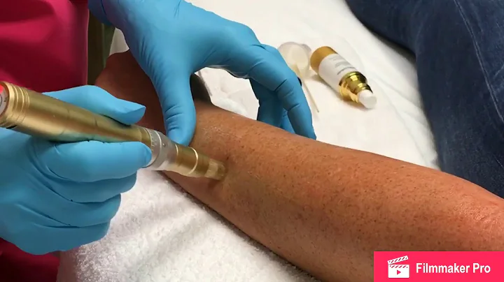 Microneedling (Arms) by LME Christy Walters