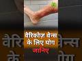 How to Treat Varicose Veins | Exercises for Varicose Veins | Yoga for Varicose Veins| Vedic Upchar |