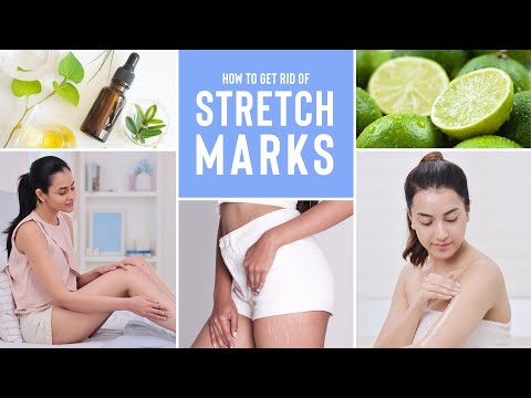 Everything You Need To Know About Stretch Marks & How To Reduce Them Using Natural Ingredients