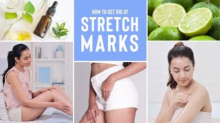 Everything You Need To Know About Stretch Marks & How To Reduce Them Using Natural Ingredients screenshot 3