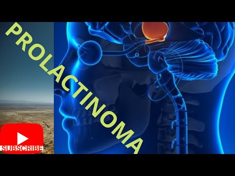 Prolactinoma ▶ Questions For/about Prolactinoma