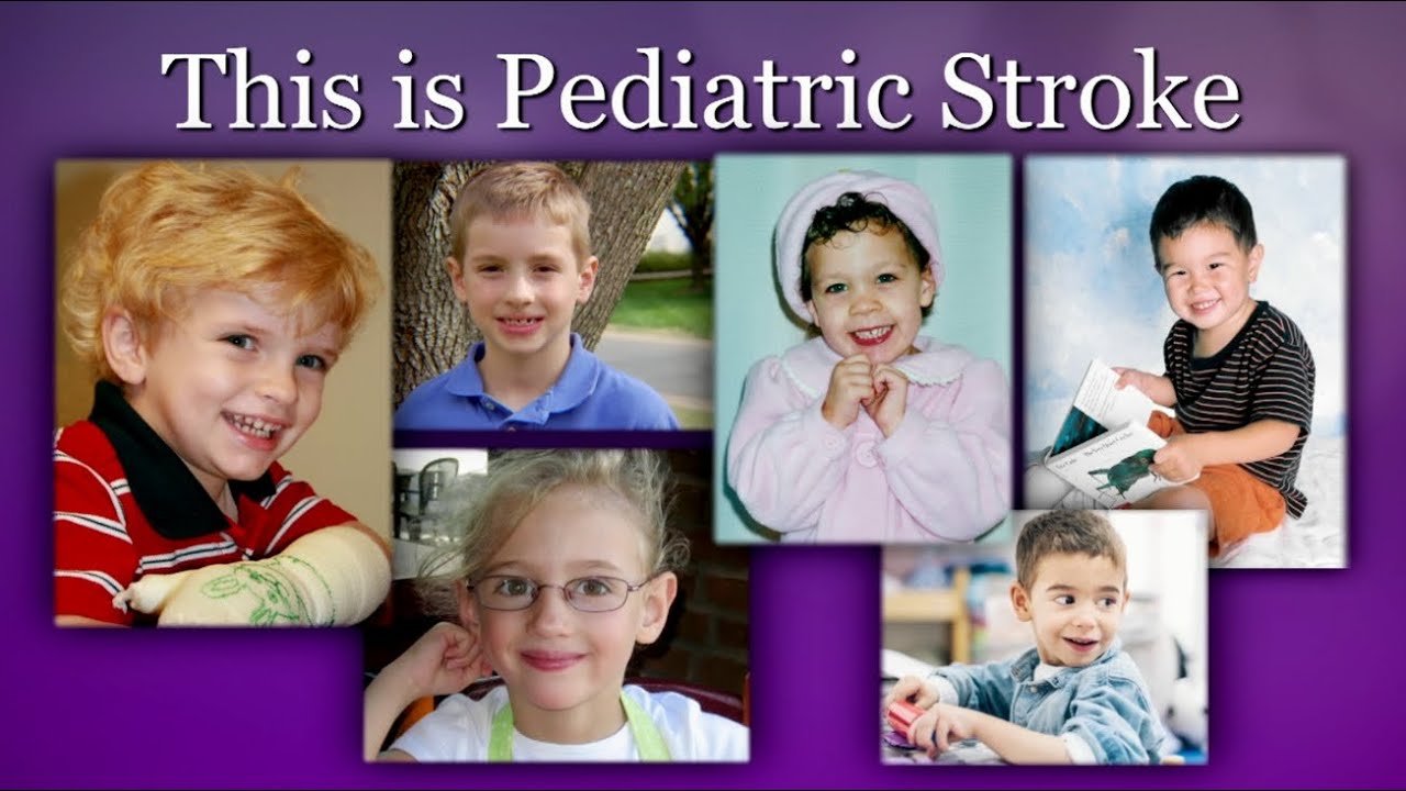 A Stroke Can Happen at Any Age YouTube