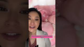 Satisfying Juicy Tonsil Stone Extraction