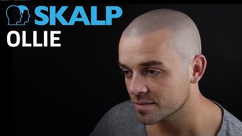 Affordable hair loss solution- Scalp micropigmentation explained by Ollie at Skalp®