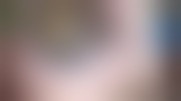 IOL Scaffold for Complicated Cataract. Ahmed Assaf