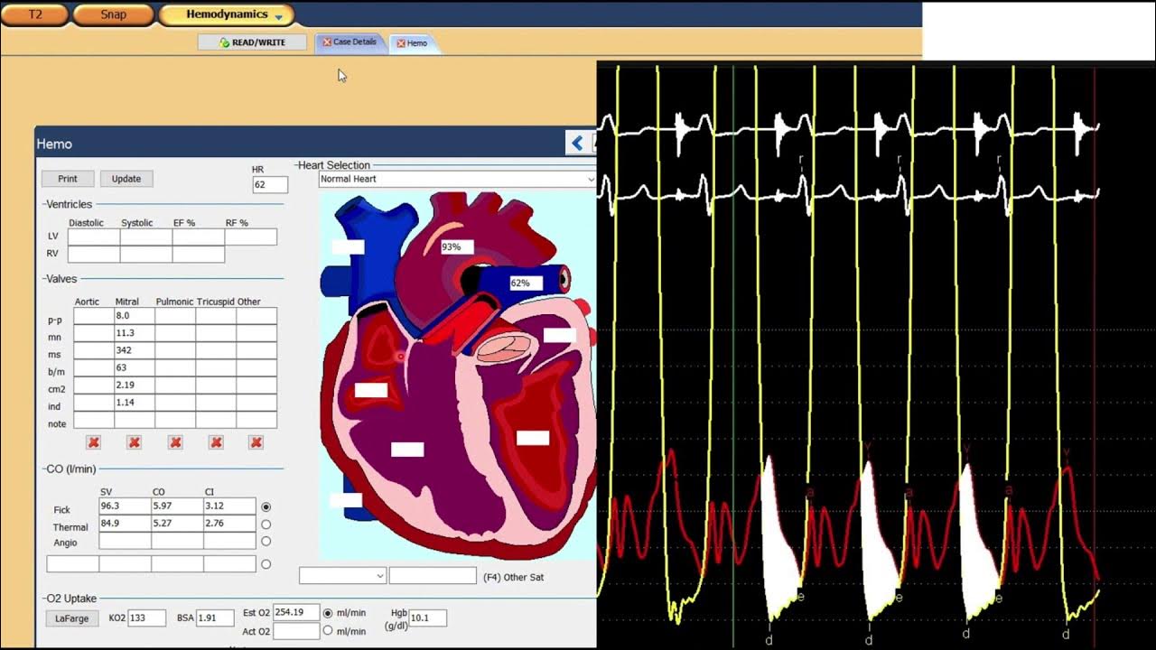 Assessing Mitral Stenosis in the Cath Lab Hemodynamic Workstation