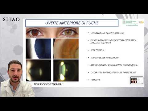 Video: Uveite Oculare: Trattamento, Sintomi, Trattamento