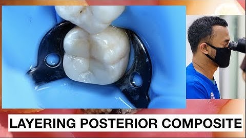 Step by Step Layering Composite Class II Distal Deep Cavity | General Dentist Griya RR