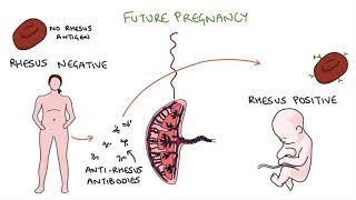 Understanding Rhesus Status and Anti-D in Pregnancy screenshot 1