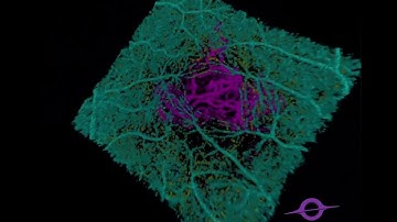 3D-OCTA Episode2: PCV in macula