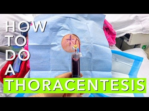 How to Do A Thoracentesis
